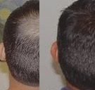 Alopecia_PRP