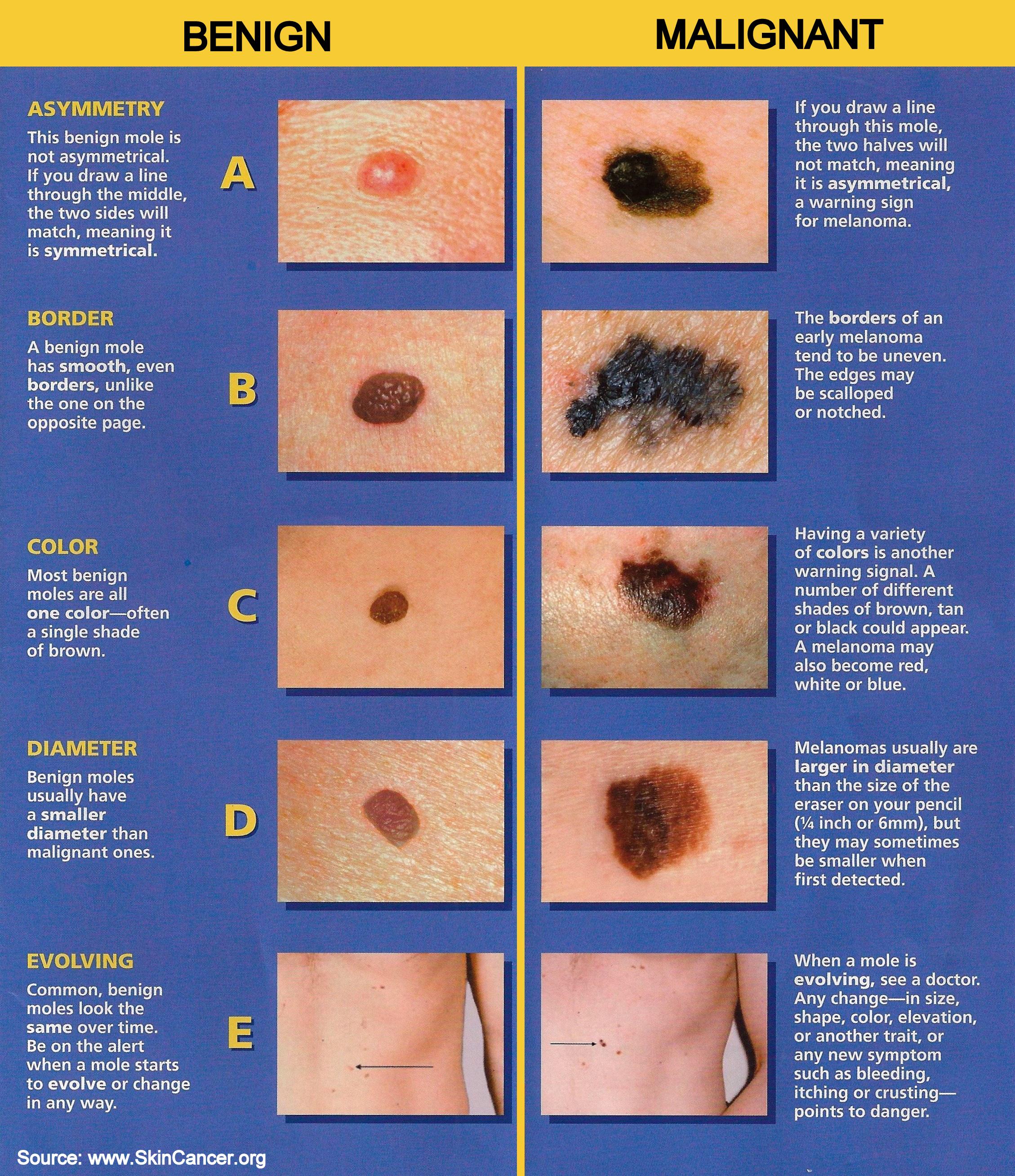 Melanoma Skin Moles