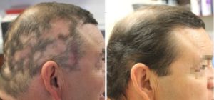 Treatment of Alopecia in San Antonio