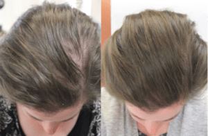 Alopecia Before and After PRP in San Antonio Alopecia Clinic